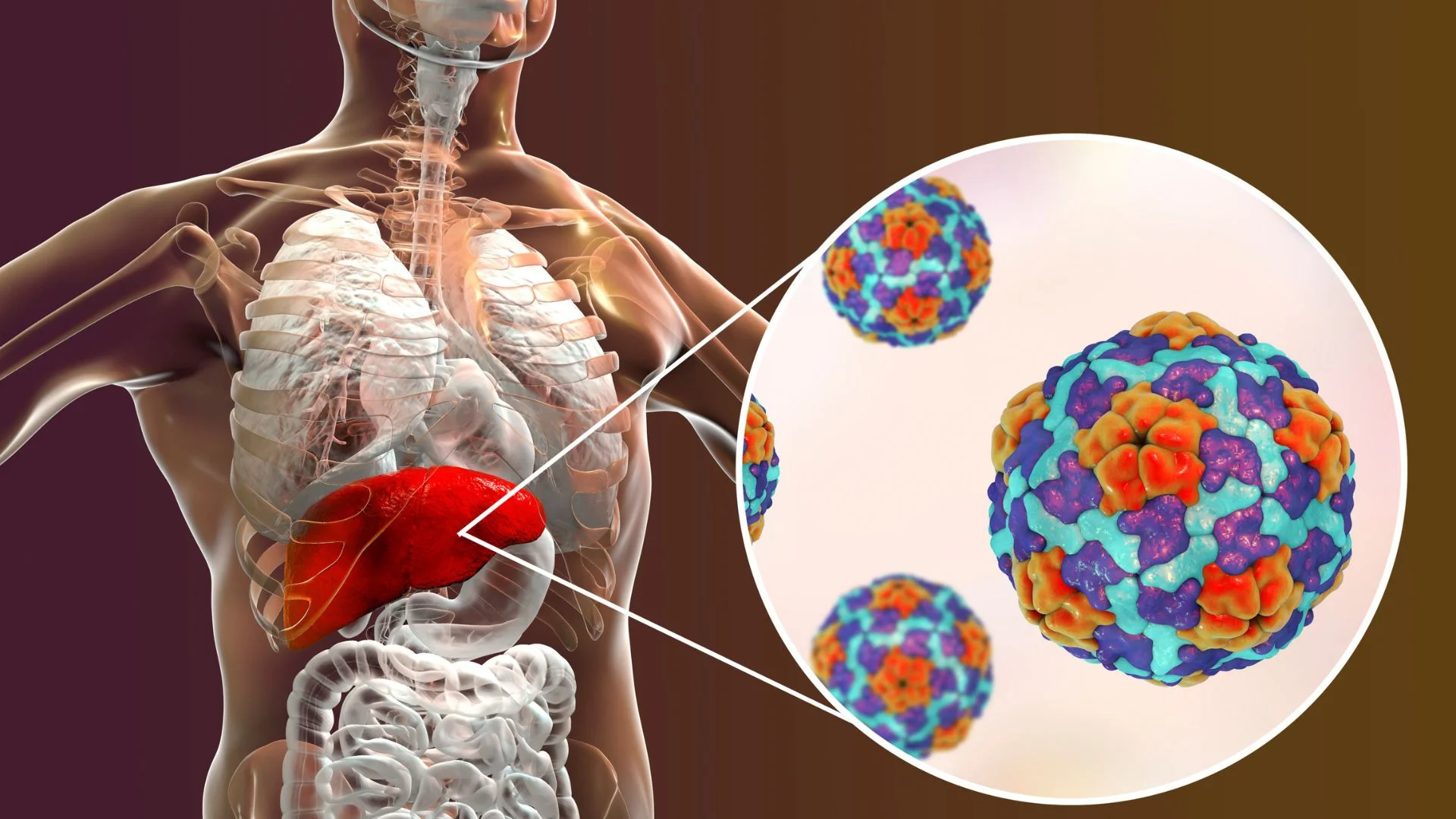 Hepatit A nedir?